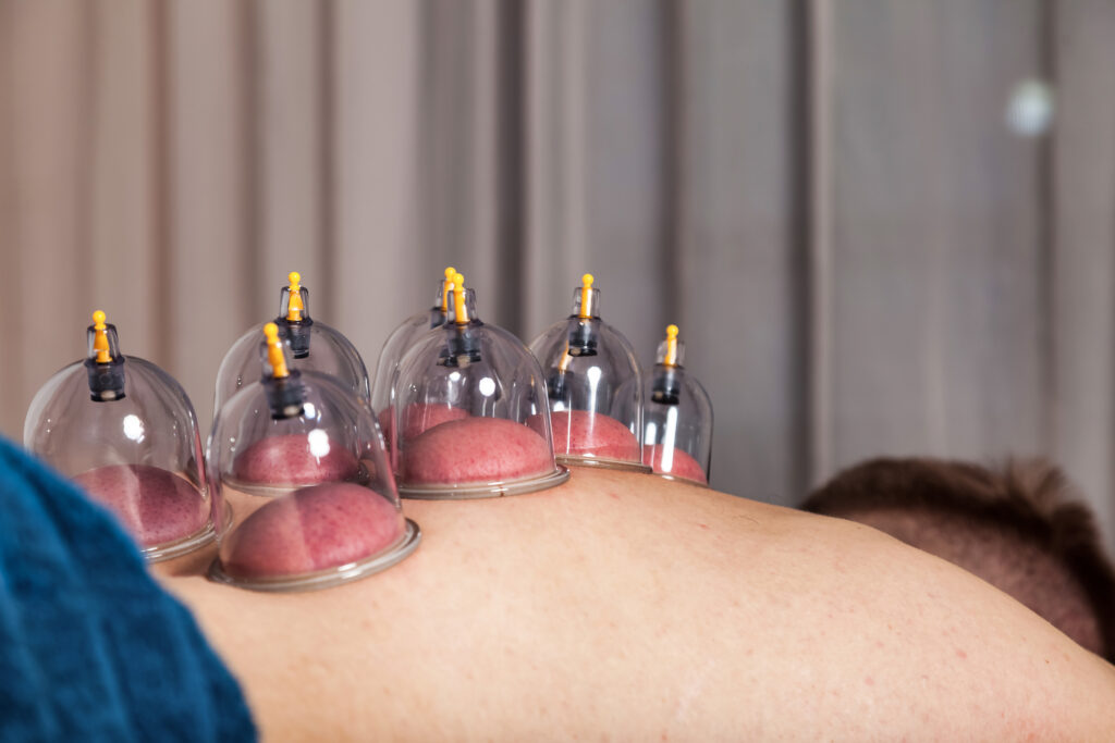 cupping hos ultimate body coach