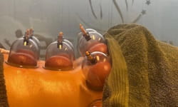 ryg hvorpå der foretages cupping