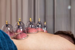 Mandlig patient med vakuumkopper i cupping terapi
